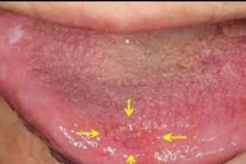 உங்கள் நாக்கில் இப்படி இருந்தால் அலட்சியப்படுத்தாதீர்கள்.. உயிருக்கே கூட ஆபத்தை ஏற்படுத்துமாம்!