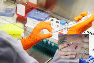 Monkeypox பரவல்... பிரித்தானிய மக்களுக்கு விடுக்கப்பட்ட எச்சரிக்கை