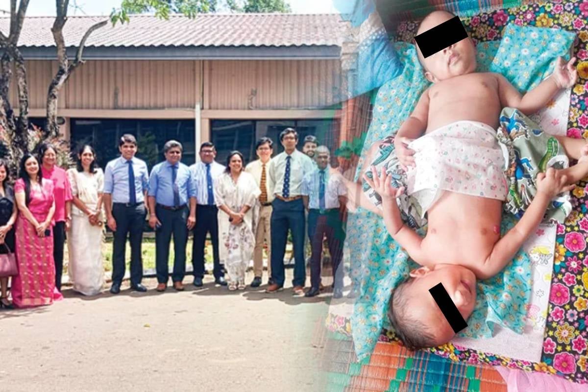 உலக வரலாற்றில் முதன்முறையாக இலங்கையில் அபூர்வ சத்திர சிகிச்சை வெற்றி | Conjoined Twins Separated By Surgery After 5 Years