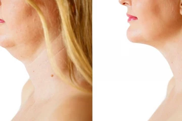 உங்க கழுத்து மட்டும் இப்படி குண்டா இருக்கா? இதனை குறைக்க வேண்டுமா? அசத்தலான டிப்ஸ் இதோ