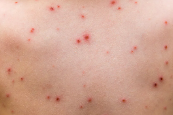 கனடாவிலும் பரவியது குரங்கு அம்மை நோய் | Monkey Pox Has Spread To Canada