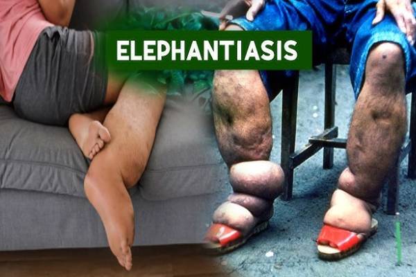 elephantiasis symptoms: யானைக்கால் நோய்... தொற்று நோயா? அறிகுறிகள் எப்படியிருக்கும்? | Elephantiasis Symptoms In Tamil