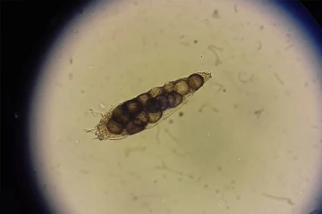 தன் கண்ணிமைகளில் உயிரினம் ஒன்று குடித்தனம் நடத்துவதை அறிந்து அதிர்ச்சியடைந்த நபர்