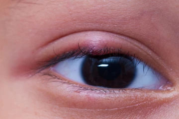 கண் கட்டி வந்தால் விரைவில் எப்படி குணப்படுத்தலாம்? இதோ சில எளிய மருத்துவம்!