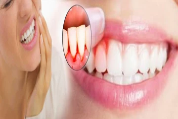 ஈறுகளில் ஏற்படும் ரத்தக்கசிவை தடுக்க வேண்டுமா? இத ட்ரை பண்ணுங்க