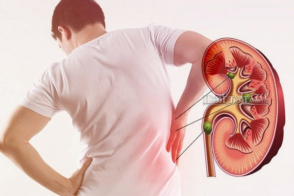 உங்கள் சிறுநீரகம் படிப்படியாக செலிழக்கின்றதா? காட்டிக்கொடுக்கும் ஐந்து நிலைகள் இதோ | Kidney Disease 5 Stages Symptoms