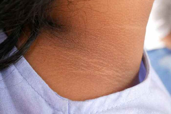 இளம் வயதிலேயே கழுத்து வயதான தோற்றத்தில் இருக்கிறதா? சுருக்கங்கள், கோடுகளை போக்குவது எப்படி? | Neck Wrinkles Home Remedy