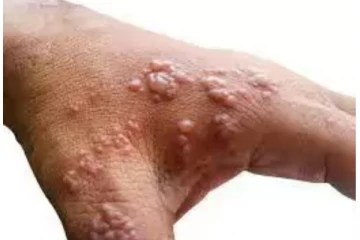 குமரியில் 4 பேருக்கு குரங்கம்மை அறிகுறி-தமிழகத்தில் தீவிரம்!