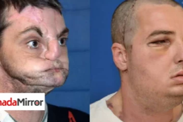 உலக வரலாற்றில் பதிவான முகம் மாற்று அறுவை சிகிச்சை! வியக்கவைத்த மருத்துவர்கள்