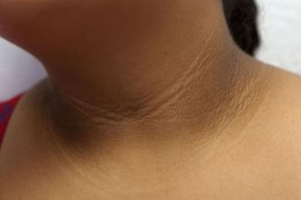 கழுத்தில் உள்ள கருமை இரண்டே வாரத்தில் நீங்க சூப்பர் டிப்ஸ் | Home Remedies To Remove Dark Neck Easily