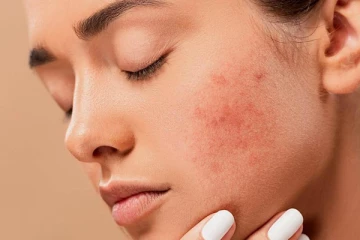 முகப்பரு பிரச்சனைகளுக்கு தீர்வு வேண்டுமா? இதோ அற்புத வழிகள்