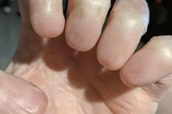 நகங்கள் இல்லாத விரல்கள் - அதிரவைக்கும் புகைப்படம்! | Viral Image Of Persons Hand Who Cant Grow Nails