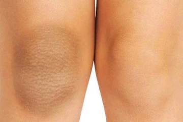 முழங்காலில் இருக்கும் கருமை அழகை கெடுக்கிறதா? உடனே போக்க சிறந்த வழி இதோ...!