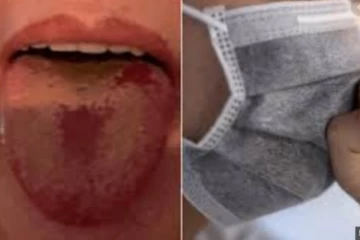 கொரோனா வைரஸின் புதிய விகாரம் “COVID TONGUE”! முழு விபரம் உள்ளே...