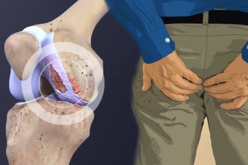 කාටිලේජ වර්ධනය කර අර්ශස් සුව කරන බර කොකු.