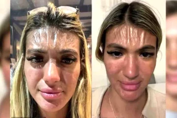 'வெயிலில் 30 நிமிடங்கள் படுத்திருந்தேன்' பிளாஸ்டிக் போல் மாறிய பிரித்தானிய பெண்ணின் முகம்!