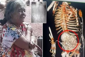 81 வயது மூதாட்டியின் வயிற்றில் இறந்த குழந்தை - அதுவும் 56 வருடங்களாக - என்ன காரணம்?