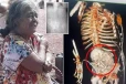 81 வயது மூதாட்டியின் வயிற்றில் இறந்த குழந்தை - அதுவும் 56 வருடங்களாக - என்ன காரணம்?