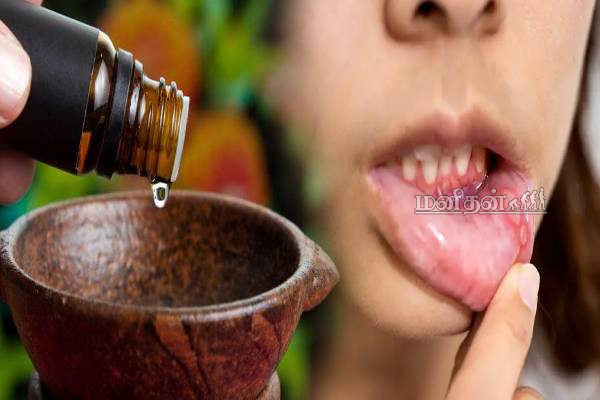 அடிக்கடி வாய்ப்புண் வருதா? ஒரே தடவையில் ஆற்றும் மருந்து உங்க வீட்டு சமையல் இருக்கே | Home Remedies To Treat Mouth Ulcers அடிக்கடி வாய்ப்புண் வருதா? ஒரே தடவையில் ஆற்றும் மருந்து உங்க வீட்டு சமையல் இருக்கே | Home Remedies To Treat Mouth Ulcers