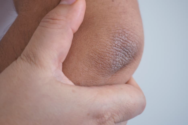 கைமுட்டிகள் மிகவும் கருப்பா இருக்கா? இந்த பொருளை நான்கு முறை போடுங்க | Home Remedies To Remove Dark Knuckles Beauty