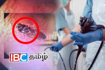 இந்தியாவில் இளைஞன் வயிற்றிலிருந்த கரப்பான் பூச்சி! அதிர்ச்சியடைந்த மருத்துவர்கள்