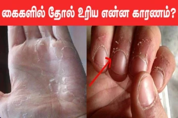 உள்ளங்கை தோல் உரியுதா? அதற்கு இது தான் காரணம்