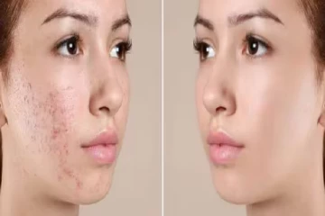 முகப்பருவை அடியோடு விரட்டும் எளிய முறைகள்