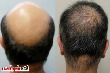 வழுக்கை தலையில் முடி வளர வைக்கும் ஸ்கால்ப் மசாஜ்! எப்படி செய்வது?