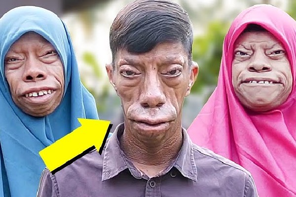 பகலில் சாதாரண மனிதன், இரவில் பல்லி முகம் கொண்ட மனிதன்! இந்தோனேசியாவில் ஆச்சரியம் | Indonesia Man Affected With Strange Face Disease