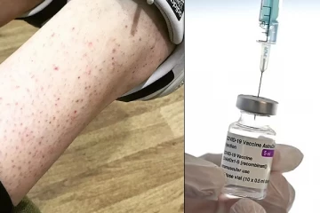 இரத்தக்கட்டிகளைத் தொடர்ந்து ஆஸ்ட்ராசெனகா தடுப்பூசியால் மீண்டும் ஒரு புதிய பிரச்சினை