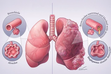 ඇදුම කියලා රැවටෙන - පිමින්ට විතරක් හැදෙන මාරාන්තික COPD ගැන අහලා තියෙනවද?