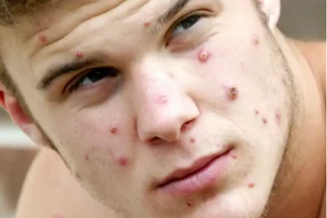 உயிரை பறிகும் அடுத்த ஆபத்து...குரங்கம்மையின் அறிகுறிகள் என்னென்ன தெரியுமா?