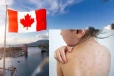 கனடாவை அச்சுறுத்தும் நோய்த்தாக்கம் : மக்களுக்கு எச்சரிக்கை விடுவிப்பு