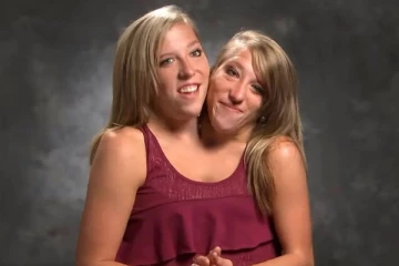 ஒட்டிப் பிறந்த இரட்டை சகோதரிகள்: 33 வயதில் என்ன செய்து கொண்டிருக்கிறார்கள்?