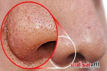 மூக்கைச் சுற்றியிருக்கும் பிடிவாதமான கரும்புள்ளி - 1நிமிடத்தில் போக இதை செய்ங்க