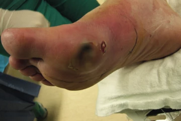 சர்க்கரை நோயாளிகள் புண் விரைவில் ஆற வேண்டுமா? இதே சிறந்த வழி