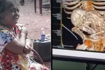 56 ஆண்டுகளாக பெண்ணின் வயிற்றில் இருந்த இறந்த குழந்தை