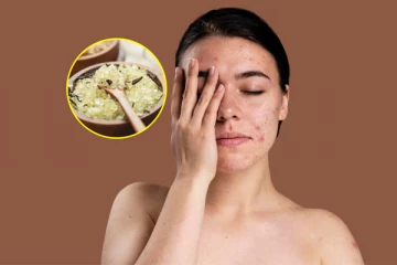 முகத்தில் இருக்கும் கரும்புள்ளியை நீக்க வேண்டுமா? இது தான் சிறந்த தீர்வு..!