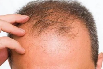 திடீரென முடி உதிர்ந்து வழுக்கை தலையாவதால் கிராம மக்கள் பீதி