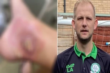 காலில் ஏற்பட்ட காயத்தை சாதாரணமாக எடுத்துகொண்ட இளைஞர்! பரிசோதனையில் தெரிய வந்த உண்மை!