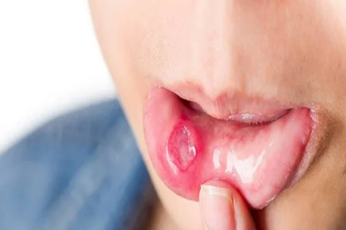 அடிக்கடி வாயில் புண் வந்தால்.. அது புற்றுநோயின் அறிகுறியா? | Get Frequent Mouth Ulcers Is That A Sign Of Cancer