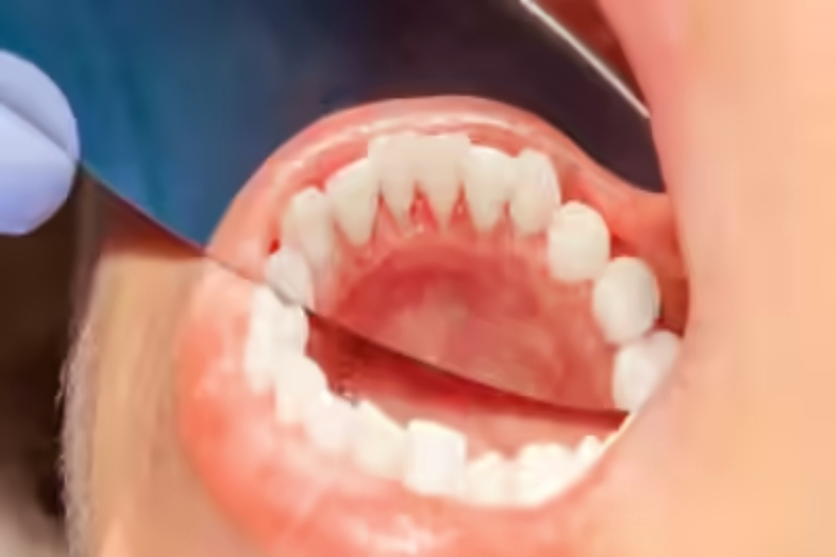 அடிக்கடி வாயில் புண் வந்தால்.. அது புற்றுநோயின் அறிகுறியா? | Get Frequent Mouth Ulcers Is That A Sign Of Cancer