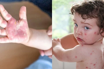 இந்தியாவில் பரவும் தக்காளி காய்ச்சல் : குழந்தைகளுக்கு எச்சரிக்கை