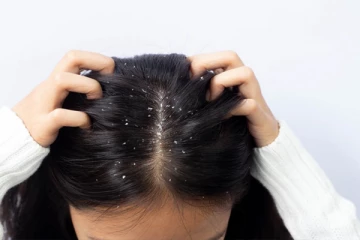 பொடுகு தொல்லையால் அவஸ்தையா? இதோ அற்புதமான வழிகள்