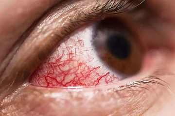 கொரோனா நோயாளிகளை அச்சுறுத்தும் Mucormycosis! அறிகுறிகள் என்ன?