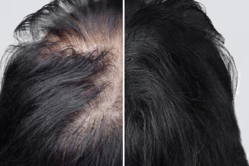 முன் நெற்றி ஏறிட்டே போகுதா? இந்த ஒரு Hair Oil போதும்