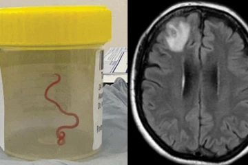பெண்ணின் மூளைக்குள் உயிருடன் கண்டுபிடிக்கப்பட்ட புழு... மருத்துவ வரலாற்றில் முதல் முறை