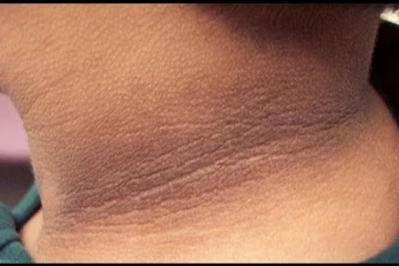 கழுத்தில் ஏற்படும் கருவளையத்தை போக்க வேண்டுமா? இதோ சில டிப்ஸ்!