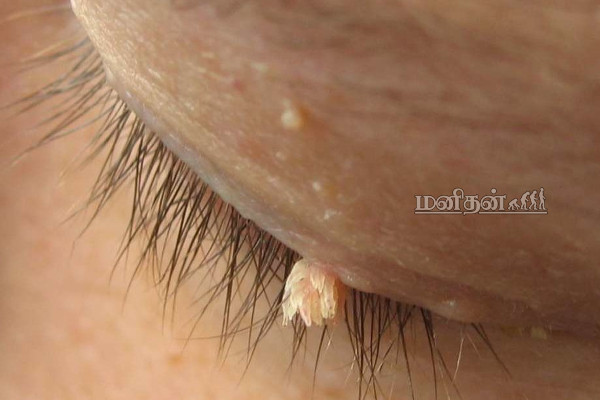 முகம், கழுத்து என மரு அசிங்க படுத்துகிறதா? வலிக்காம உதிர இந்த சாதாரண உணவு பொருட்கள் போதும்! | Tips For Warts Helthy Tips