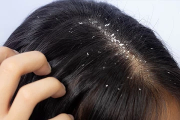 பொடுகு பிரச்சினையா? இதனை எளியமுறையில் விரட்டி அடிக்க இதோ சில அசத்தலான டிப்ஸ்